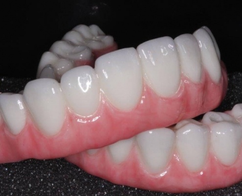 Full Mouth Implant Teeth