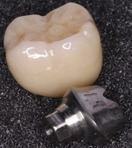 dental implant molar