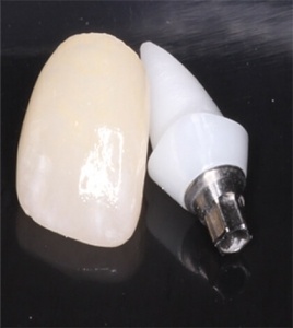 implant front tooth