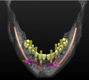 panoramic jaw x-ray