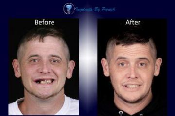 Dental Implant Before and After Aarron 