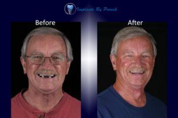 Dental Implant Before and After Steve